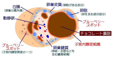 破裂や癌になる事もある 卵巣チョコレート嚢胞 あなたの不妊の原因と対策は 子供が妊娠しやすい体を作ろう